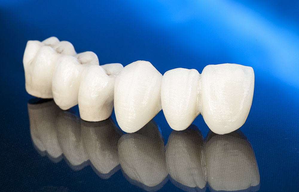 Tooth-Colored Fillings (Composite Restorations) in Hayward, CA