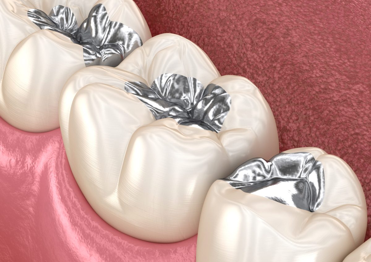 Amalgam restoration. Medically accurate 3D animation of dental concept