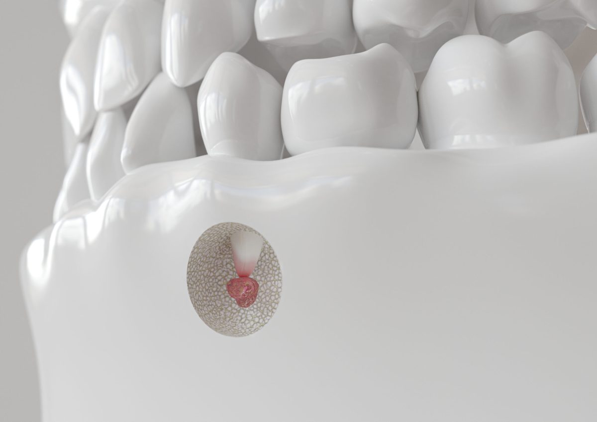 Root tip inflammation with apicectomy -- 3D rendering