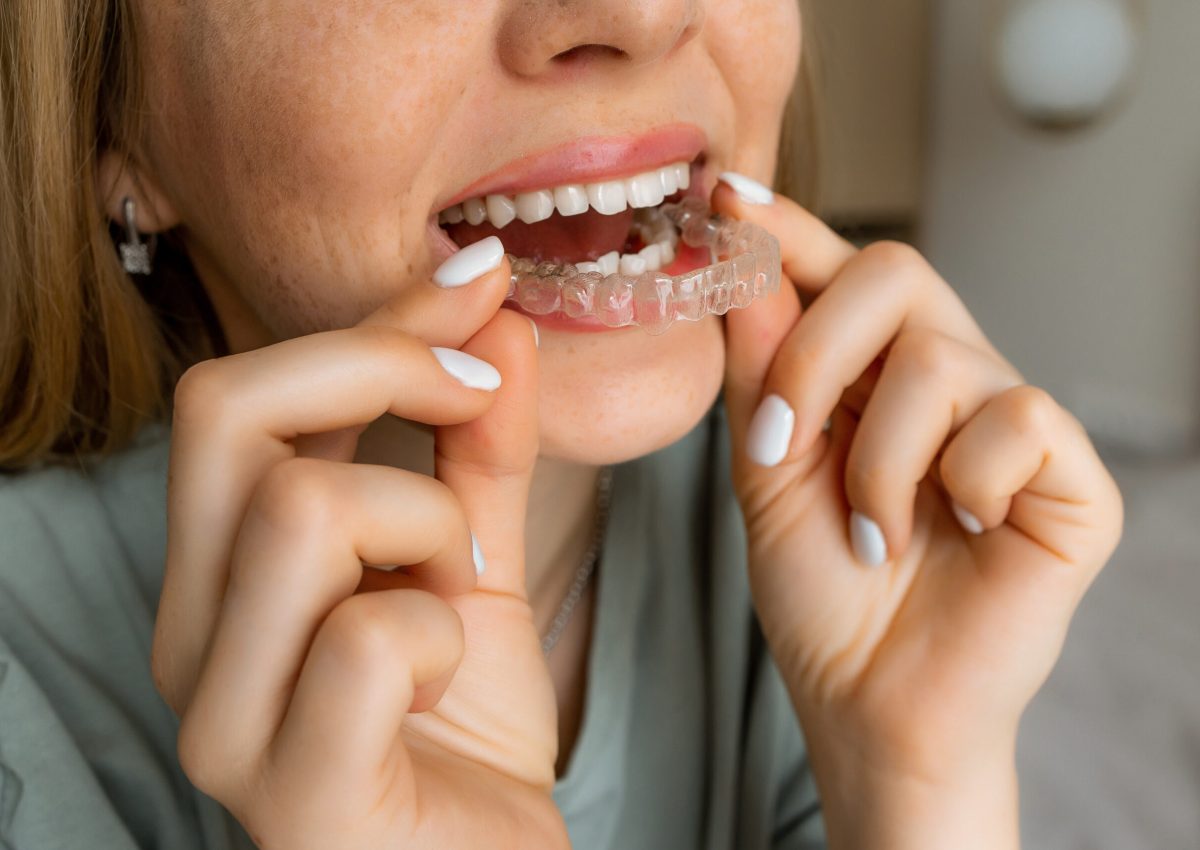 A close-up view of a woman carefully placing a transparent dental aligner over her teeth. oral care, dental appliances, and maintaining a healthy smile with modern orthodontic solutions.