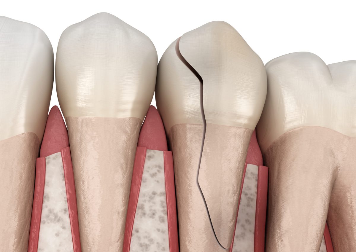 Cracked tooth, splitted. Dental 3D illustration