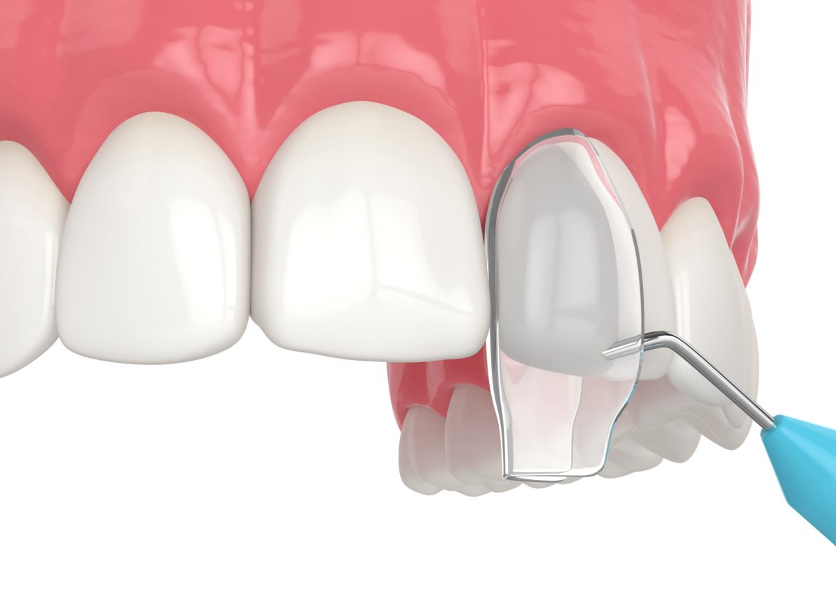 3d render of crooked tooth treatment using bonding procedure