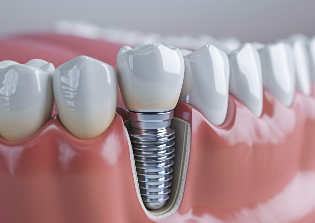 3d illustration of a titanium dental implant in the lower jaw