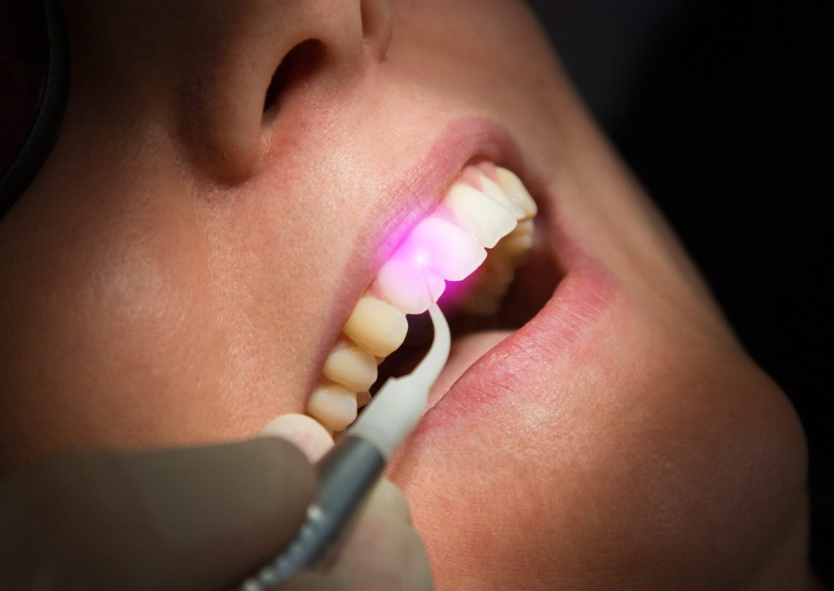 Dental Laser Zahnbehandlung Zahnfleisch