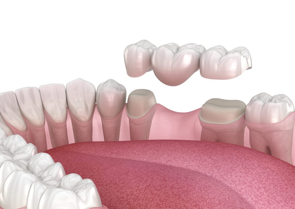 Dental bridge of 3 teeth over molar and premolar. Medically accurate 3D illustration of human teeth treatment