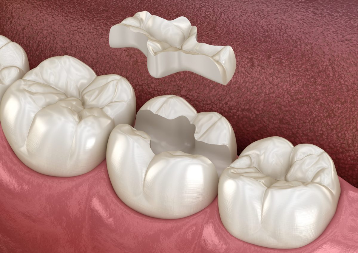 Inlay ceramic crown fixation over tooth. Medically accurate 3D illustration of human teeth treatment