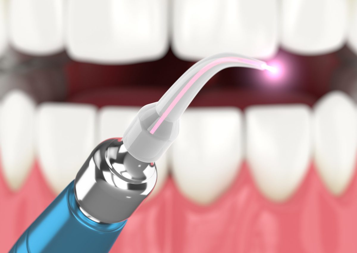 3d render of dental diode laser used to treat gums. The concept of using laser therapy in the treatment of gums