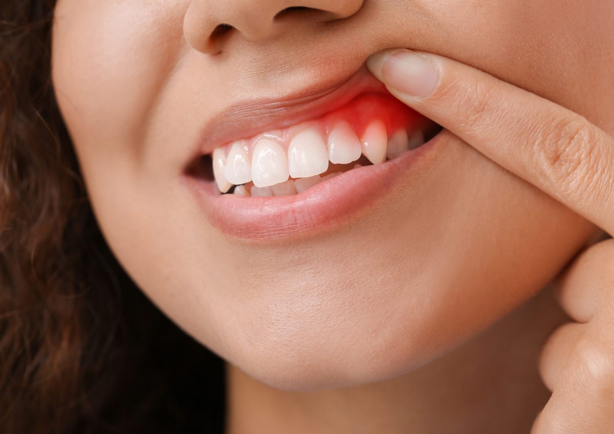 Woman with gum inflammation, closeup