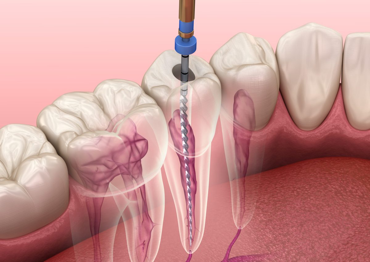 Endodontic root canal treatment process. Medically accurate tooth 3D illustration.