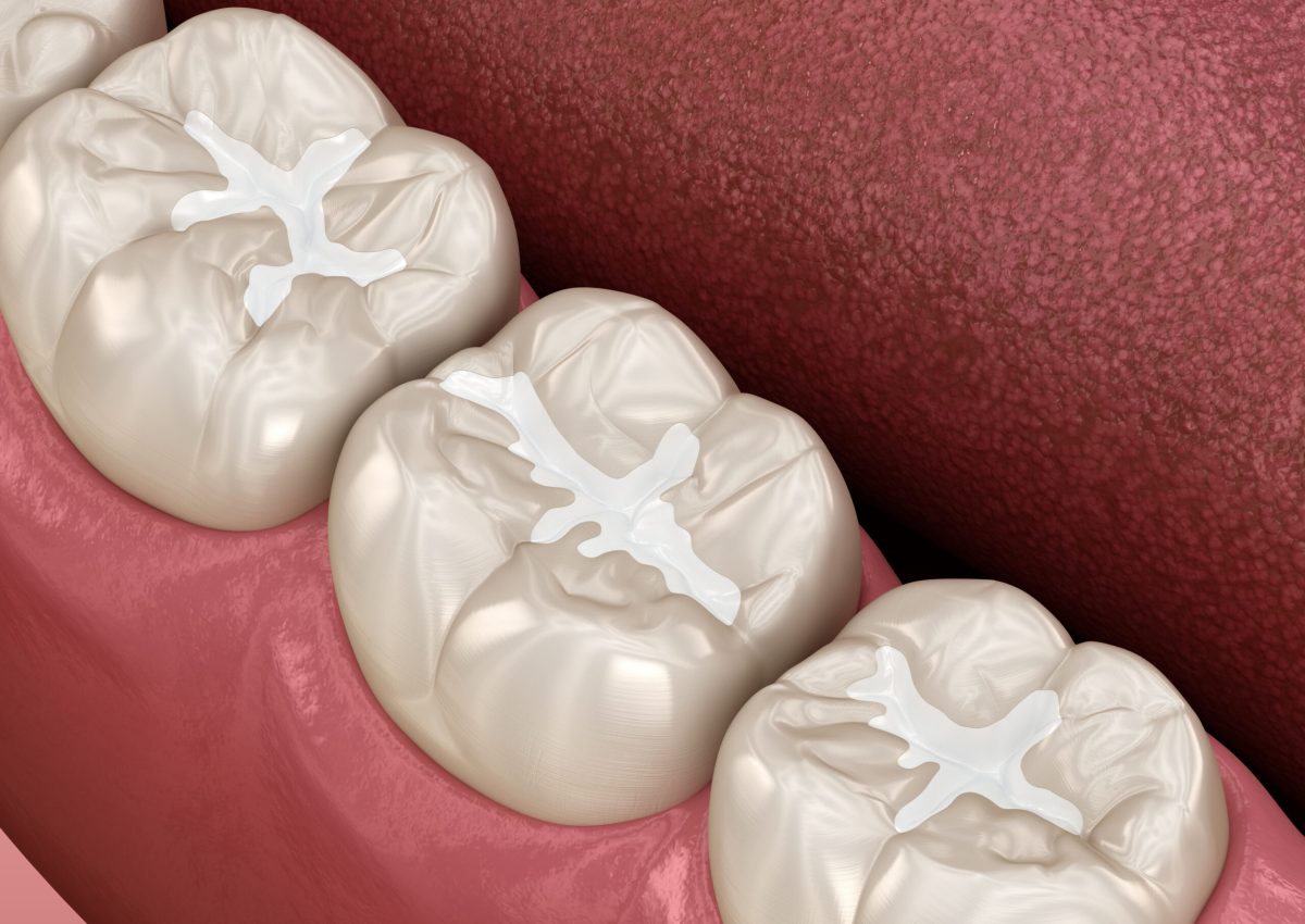 Molar Fissure dental fillings, Medically accurate 3D illustration of dental concept