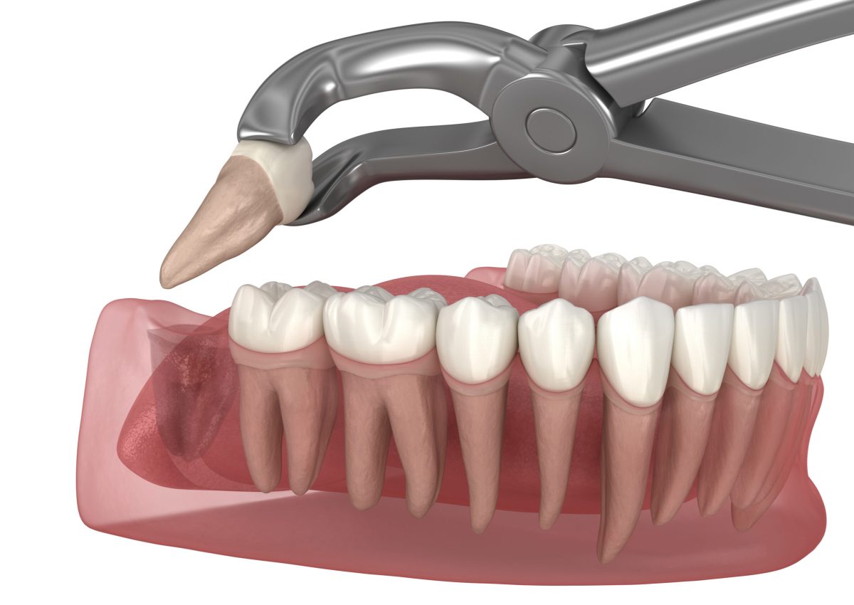 Extraction of wisdom tooth. Medically accurate tooth 3D illustration.