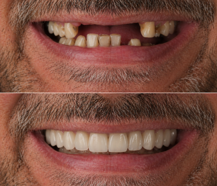 dental-impants